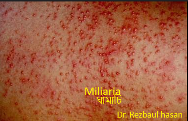 Miliaria বা ঘামাচি কি? কেনো হয়? প্রতিকার কি….?