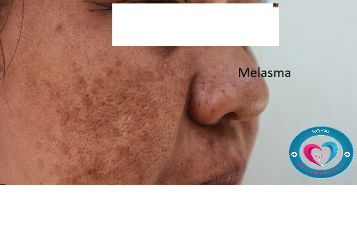 Melasma বা মেসতা হলো একটি Hyperpigmentation রোগ..