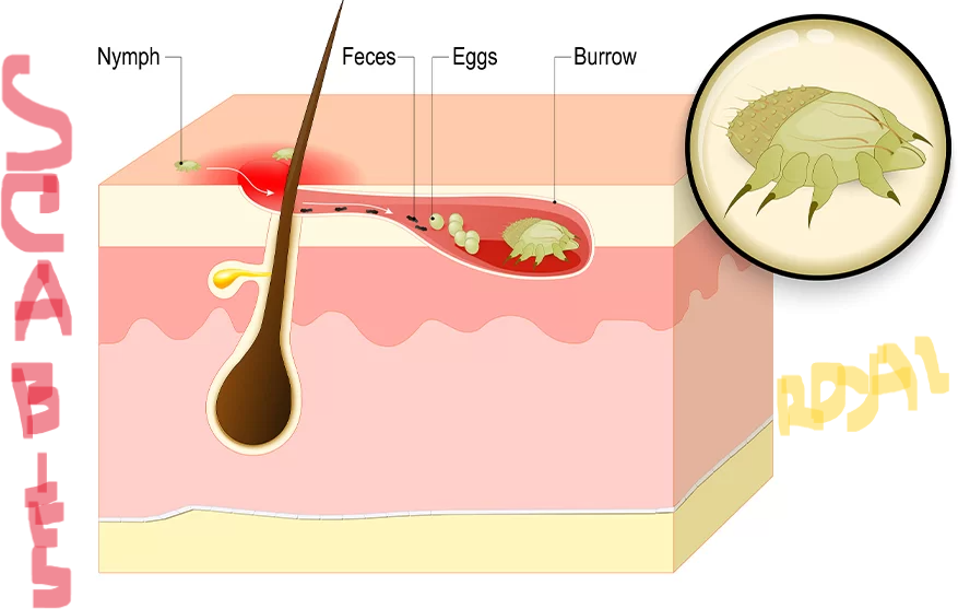 Scabies (বাংলায় খোশ,পাচড়া)